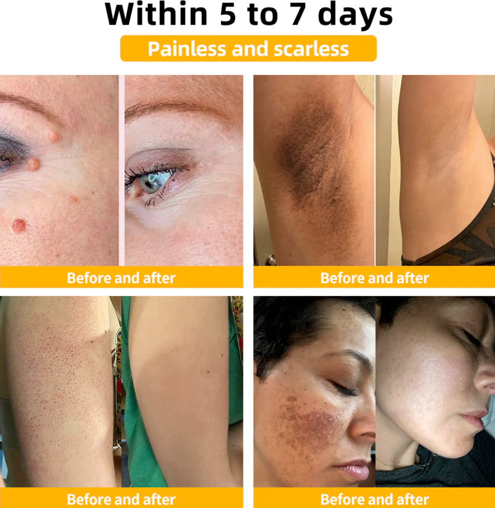 Bee Venom Treatment