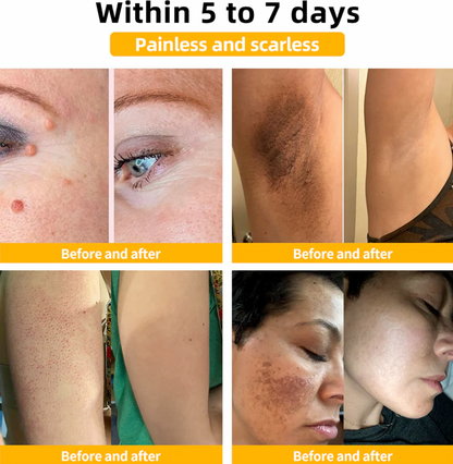 Bee Venom Treatment