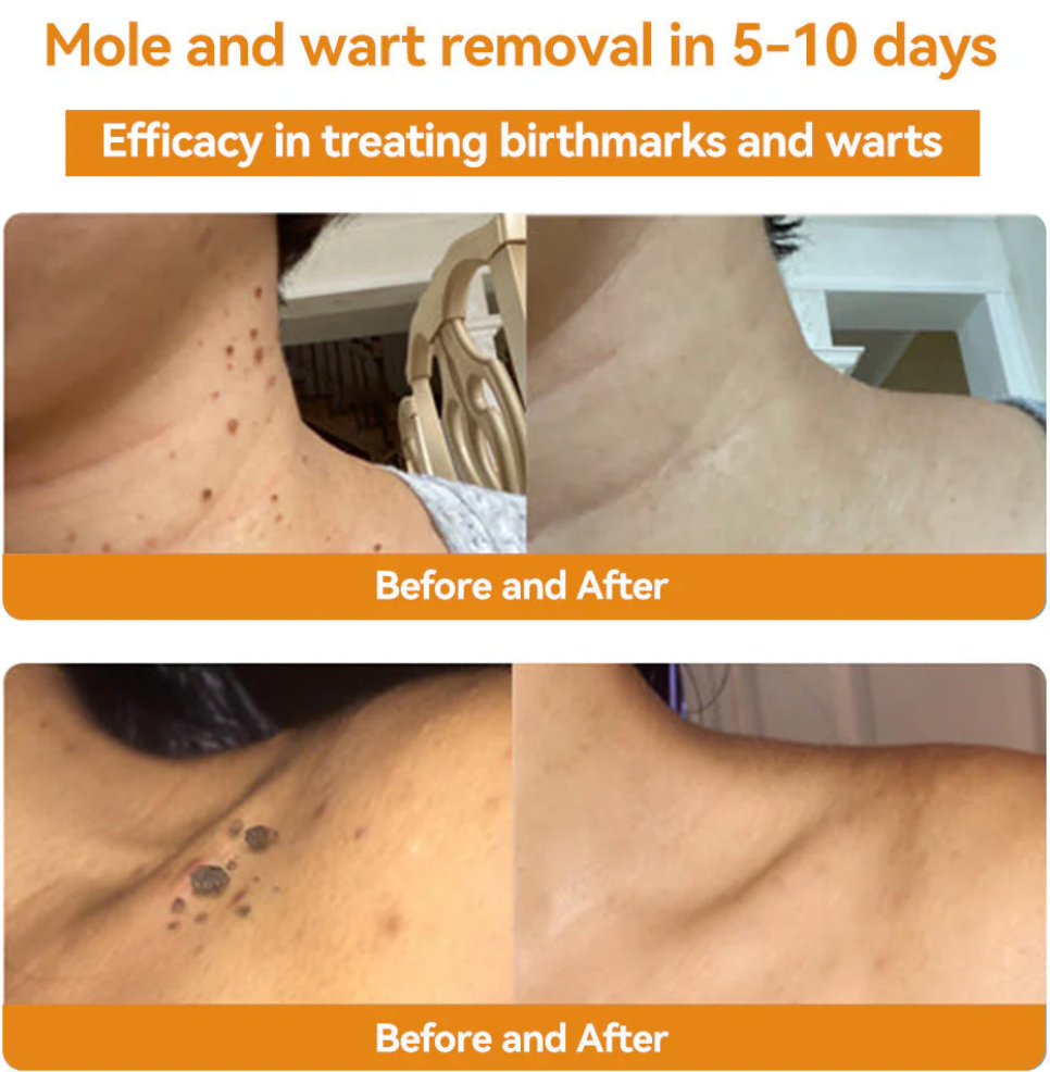 Bee Venom Treatment